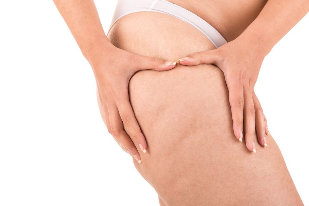Lipödem Behandlung und Schmerztherapie: Möglichkeiten zur Linderung